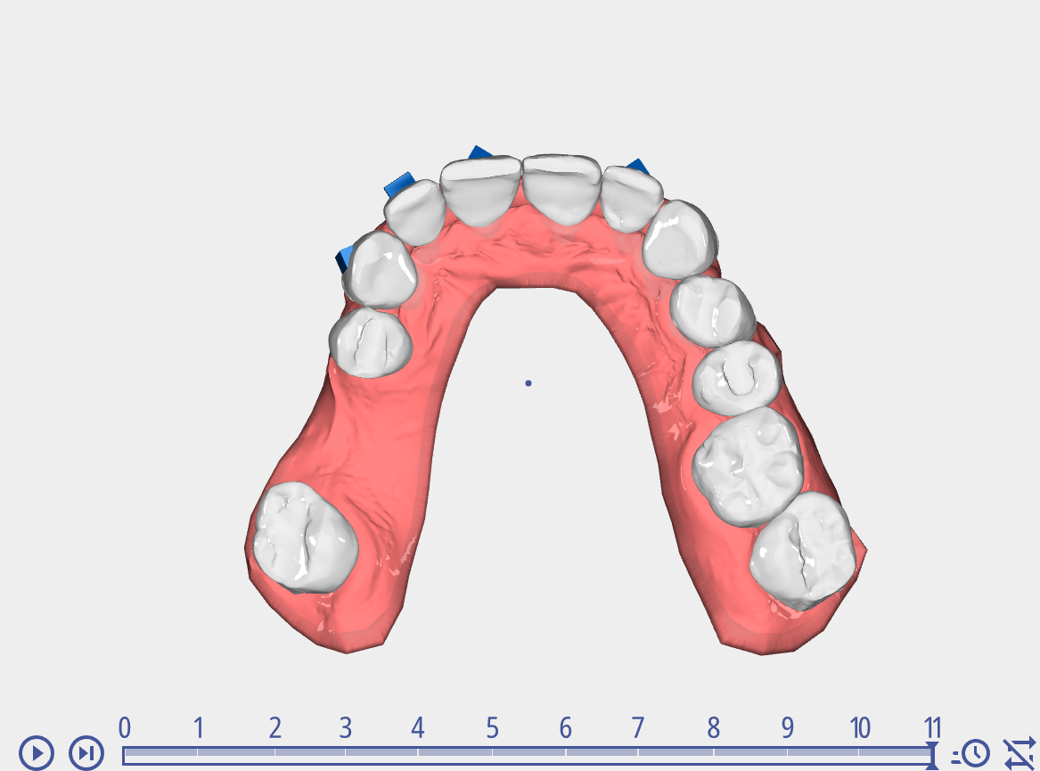 EVEN aligner treatment plan